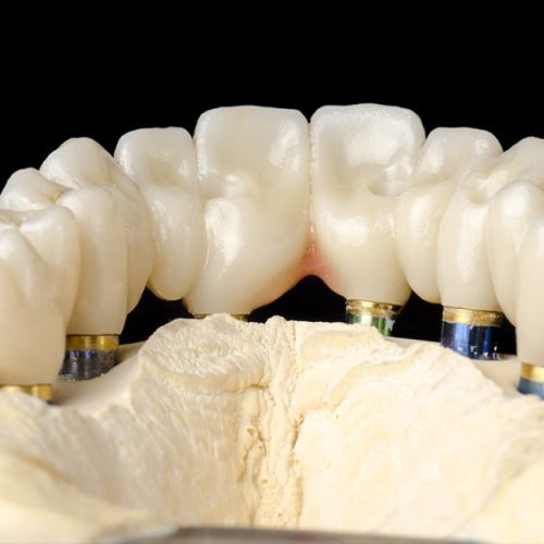 Dental-Implants- DR TEMAM DENTAL CLINIC
