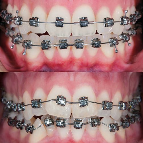 Fixed orthodontic appliances to straighten crooked or misaligned teeth. Before and after photo. Selective focus.