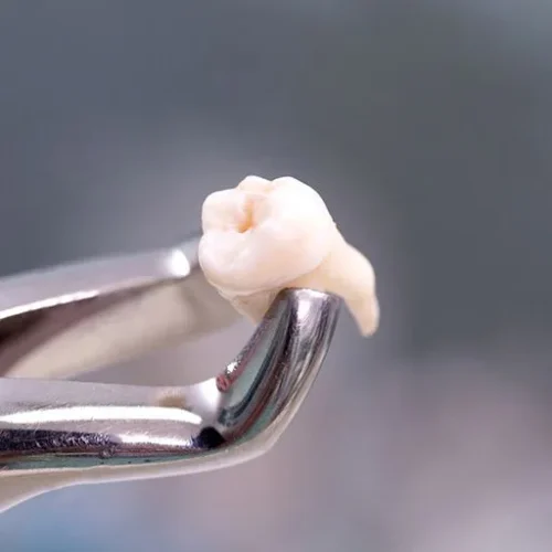 tooth-extraction-DR. TEMA DENTAL